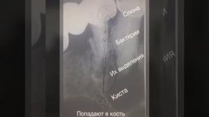 Как кариес приводит к образованию корневой кисты