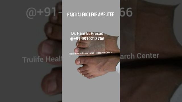 Silicone Prosthesis For Foot & Toe Amputee & Birth Defect in India Nepal Bihar Kolkata Punjab