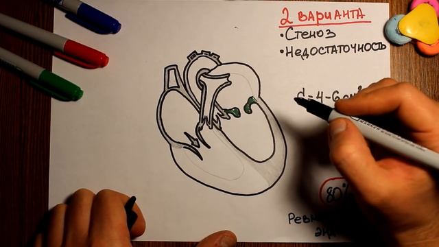Митральный стеноз. Гемодинамика при пороках сердца. - "Просто о сложном" -