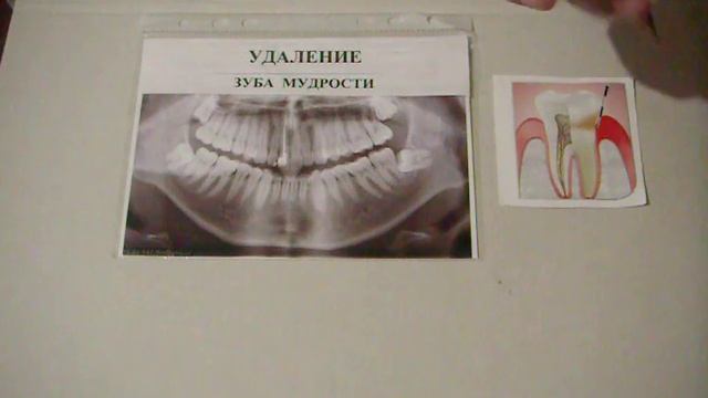 УДАЛЕНИЕ ЗУБОВ МУДРОСТИ. Зачем? Когда? Что делать после удаления? смотреть онлайн