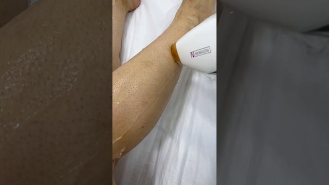 #лазернаяэпиляция #рекомендации #эпиляция #топ
