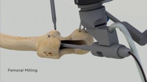 3D анимация: эндопротезирование тазобедренного  сустава