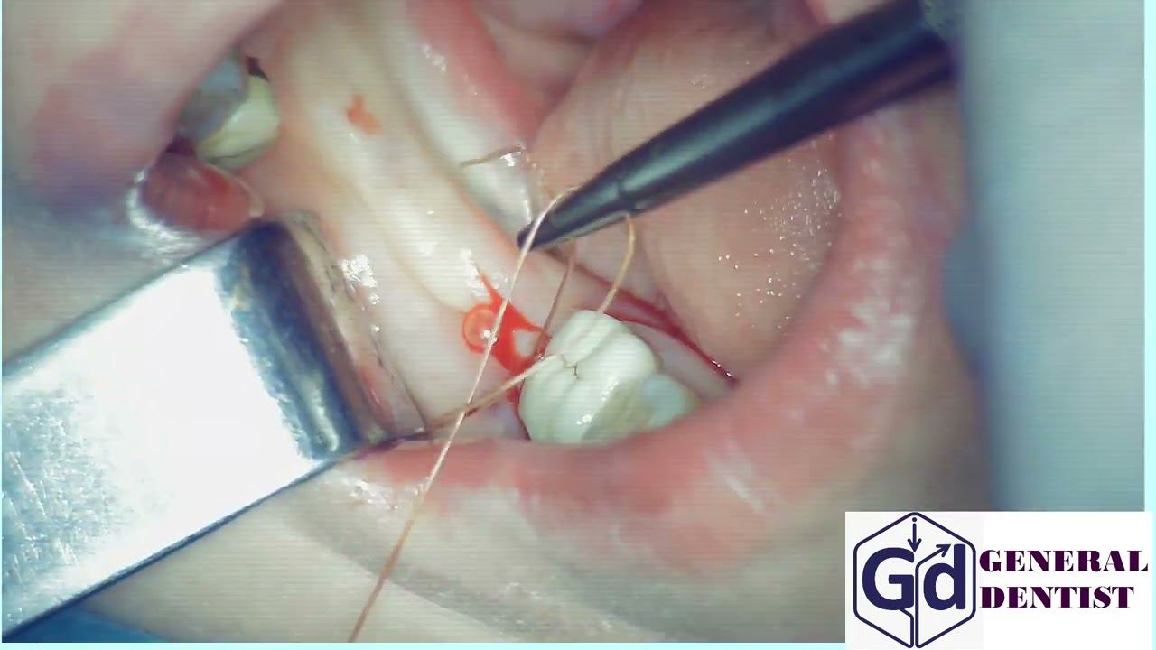 The imposition of interrupted sutures from Catgut 3. 0.\  Kniting on the Castelvoejo tool.