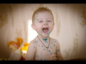 Ветрянка у детей: что необходимо знать родителям