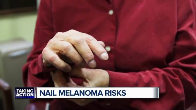 Nail melanomas смотреть онлайн