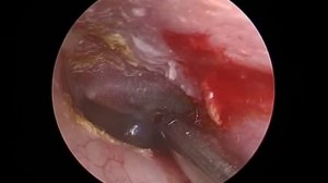 Шунтирование барабанной перепонки. Ear ventilation tube insertion.