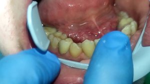 протезирование зубов