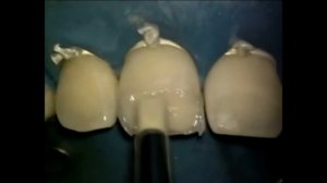 Реставрация фронтальных зубов Enamel Plus