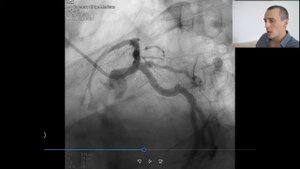 Коронарография. Левый тип кровоснабжения миокарда