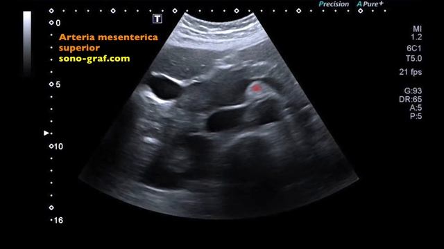 Sonografie - Pancreas смотреть онлайн