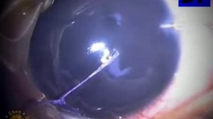 Хирургия глаукомы  (Glaucoma Surgery) - 10