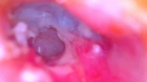 краевая перфорация барабанной перепонки