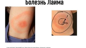 Болезнь Лайма. Боррелиоз. Сыпь. Укус клеща #подготовкакusmle#сыпь#боррелиоз#укусклеща#болезньлайма