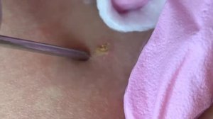 Удаление невусов