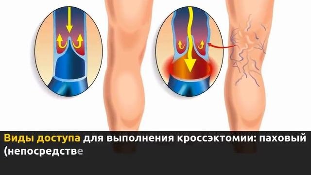 Удаление большой подкожной вены