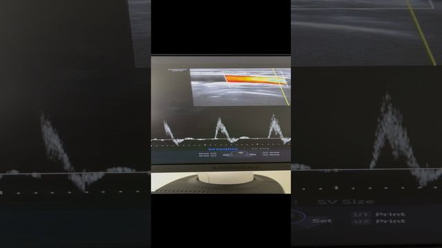 Обследование сосудов. Узи артерий. Сосудистый хирург. Флеболог Москва. Флеболог. смотреть онлайн