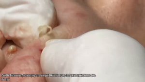 Blackheads, Cysts, Tonsil Stones and Ear Wax Removal!