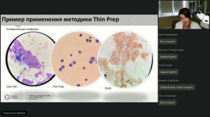 Опыт применения жидкостной цитологии в дифференциальной диагностике выпотных жидкостей.