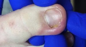 Вросший ноготь + онихолизис ???⚠️?