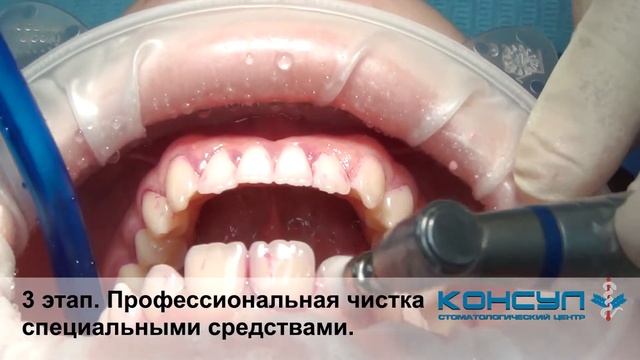 Профессиональная гигиена полости рта. Все этапы. Стоматологический центр "Консул"