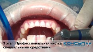 Профессиональная гигиена полости рта. Все этапы. Стоматологический центр "Консул"