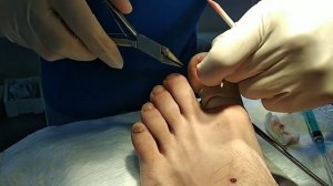 Тирноқнинг ичига ўсиши. Toenail ingrown. Вросший ноготь.