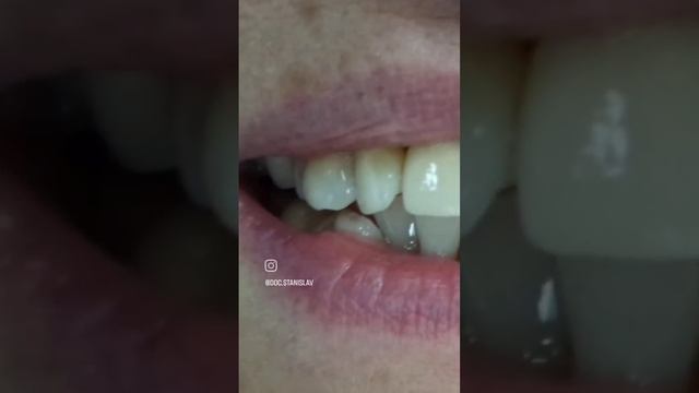 коронки на передние зубы #СтоматологКраснодар #цирконий #винирыназубы #имплантациязубов смотреть онлайн