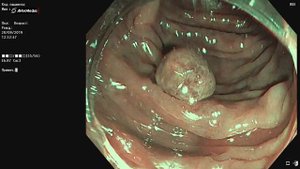 Эпителиальное новообразование толстой кишки (пишите в комментарии предполагаемую гистологию)
