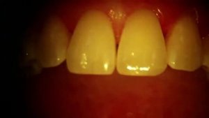 реставрация скола на переднем зубе