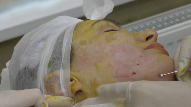 Постановка нитей EPITICON (Jetema, Южная Корея): формирование овала лица. смотреть онлайн