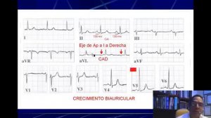 ELECTROCARDIOGRAFIA CURSO TALLER 7  HIPERTROFIAS VENTRICULARES