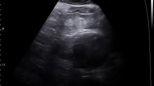 Разрыв аневризмы брюшного отдела аорты (АБА)