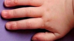 КАК РЕБЕНКУ ВЫВЕСТИ БОРОДАВКУ БЕЗБОЛЕЗНЕННО!!!