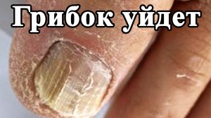 Лечение грибка. Народное средство от Грибка ногтей