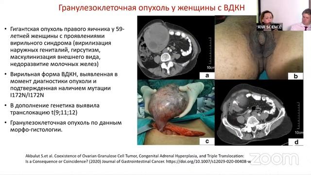 Врожденная дисфункция коры надпочечников. Синдром эктопии ткани надпочечников в яичники