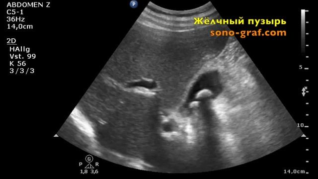 206 - УЗИ - Камни в желчном пузыре смотреть онлайн