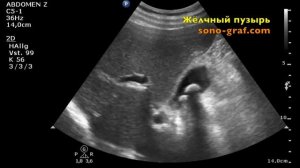 206 - УЗИ - Камни в желчном пузыре