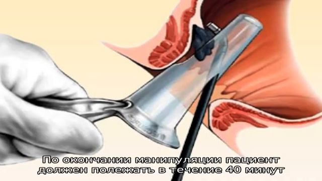 Лазерное удаление геморроя смотреть онлайн