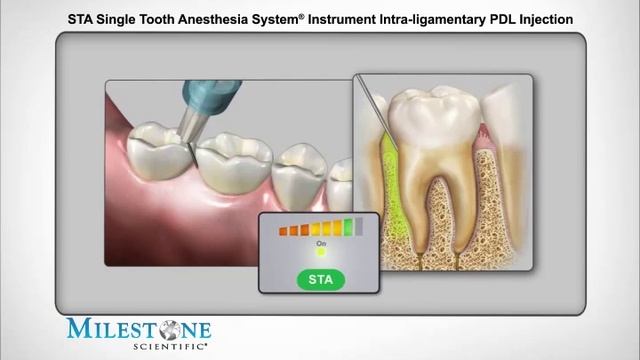 Интрасептальная анестезия. Пародонтальная интралигаментарная анестезия. Интралигаментарная анестезия и инфильтрационная. Анестезия инфильтрационная sta. Интралегаментарная Анастез.