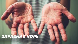 Воскрешение древней болезни. Грозит ли России эпидемия кори?