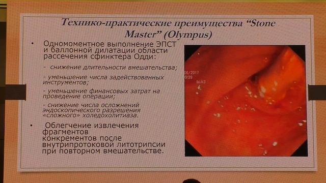 17 Будзинский СА Современные, эффективные и общедоступные варианты лечения холедохолитиаза смотреть онлайн