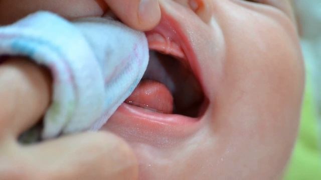 МОЛОЧНИЦА У ДЕТЕЙ | Причины появления, симптомы и лечение смотреть онлайн