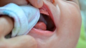 МОЛОЧНИЦА У ДЕТЕЙ | Причины появления, симптомы и лечение