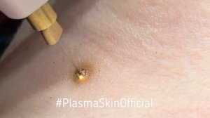 Удаление папиллом. PlasmaSkinEducation