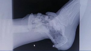 В ЛНР врачи провели уникальную операцию - достали из ноги бойца снаряд от гранатомета