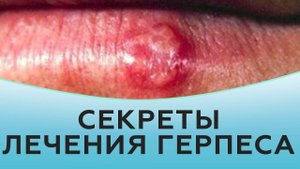 Секреты лечения герпеса.
