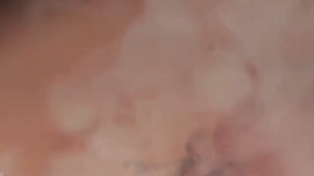 Лазерная эпиляция смотреть онлайн