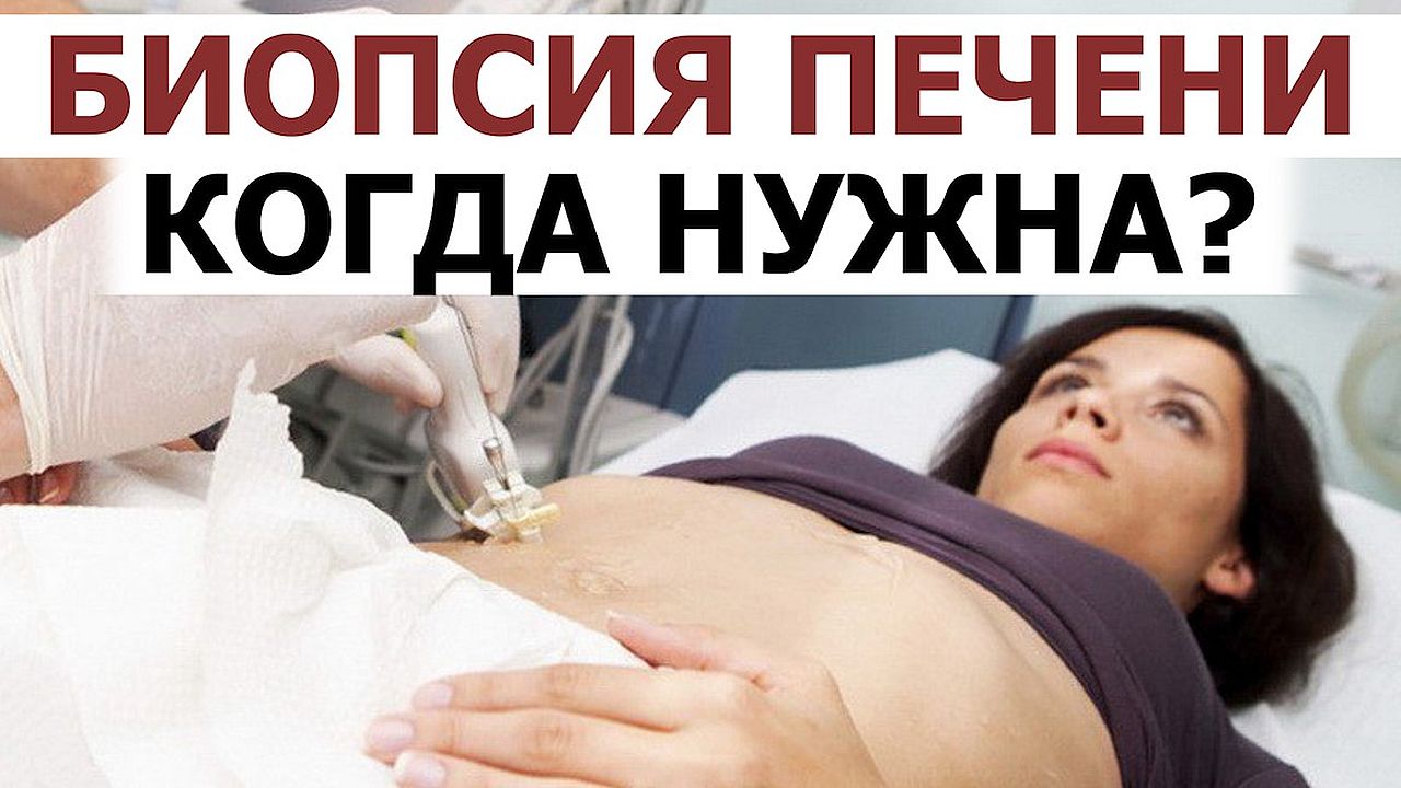 Биопсия печени при ожирении. Причина стеатогепатита диагностика. Прогрессирование фиброза печени.