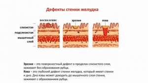 Острый гастрит