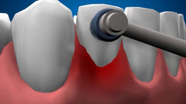 гингивит, лечение, гигиена смотреть онлайн